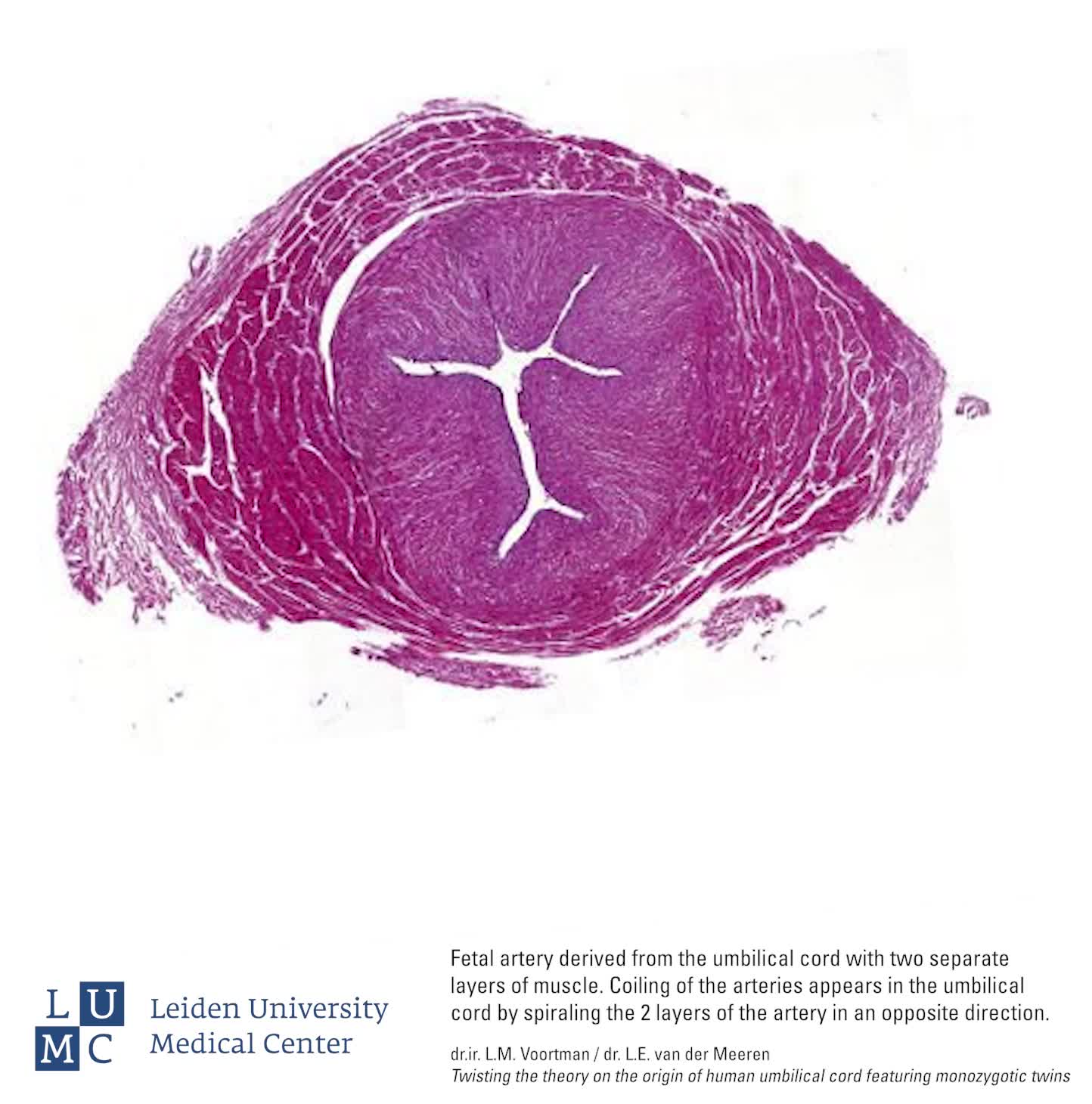 Twisting the theory on the origin of human umbilical cord coiling featuring  monozygotic twins | Life Science Alliance